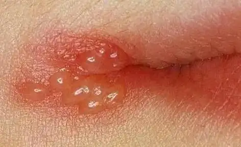 嘴唇长泡因上火?得了口唇疱疹还蒙在鼓里