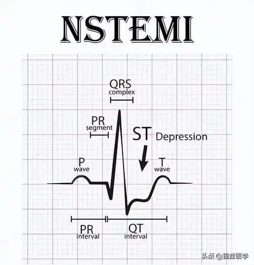 四步法快速判断心肌梗死的梗死部位和范围