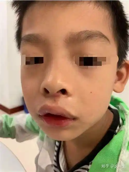 腺样体面容长什么样?怀疑腺样体肥大怎么办