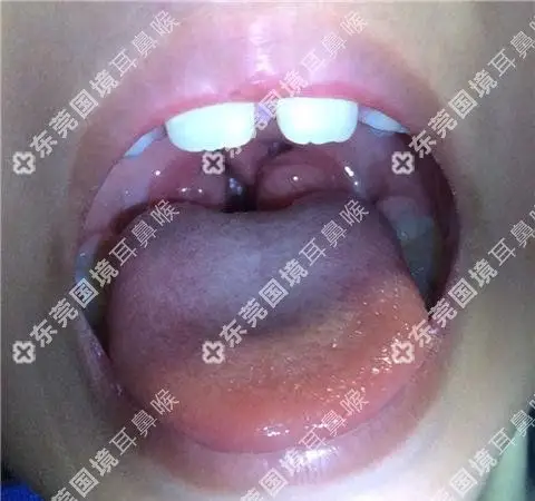 轻松解决扁桃体肥大