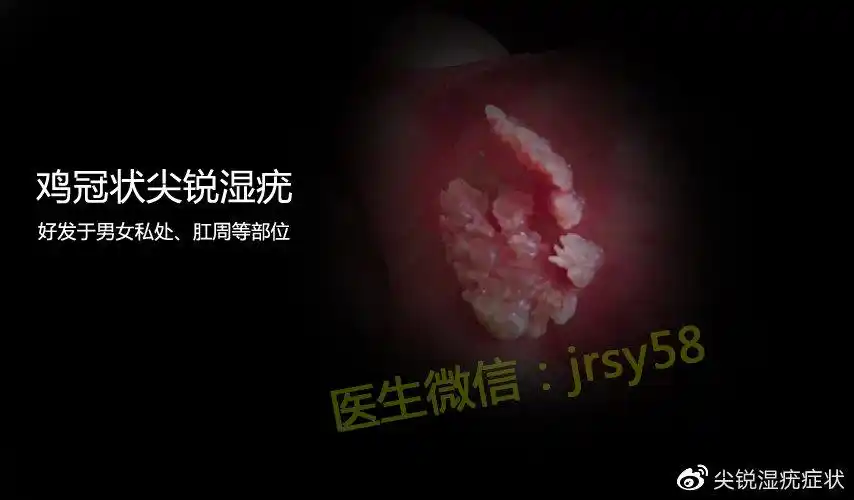 尖锐湿疣是什么样子图片大全初期