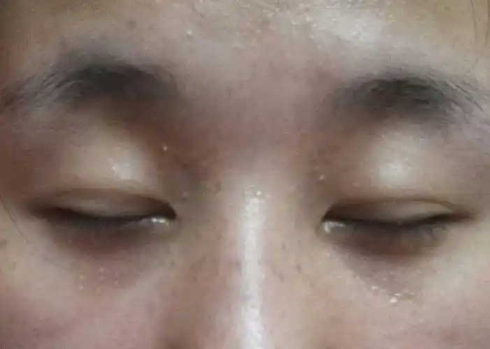 眼周长的颗粒,好几年了,不是脂肪粒,有人说是扁平疣,有人说是汗管瘤