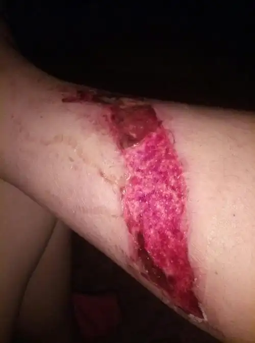 急!前几天开车摔了 小腿刮掉你个一块皮里面是白色的