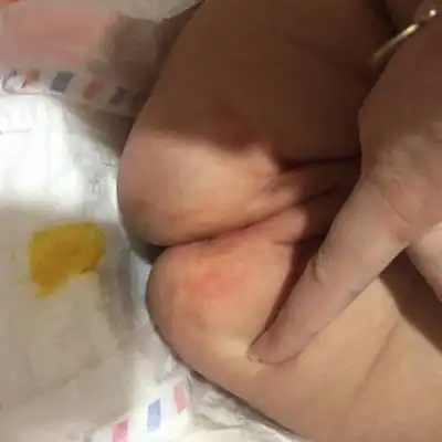 问答 婴儿期0-1岁 育儿问题这裏搜 取消 最佳回答          这是红