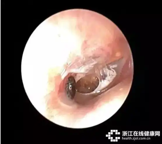 耳朵里钻进一只蟑螂医生取出来时还是活的万一虫子入耳三件事绝对不能