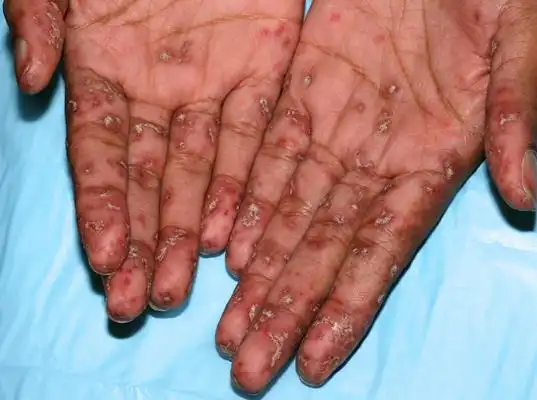 艾滋病红斑图片 (59)