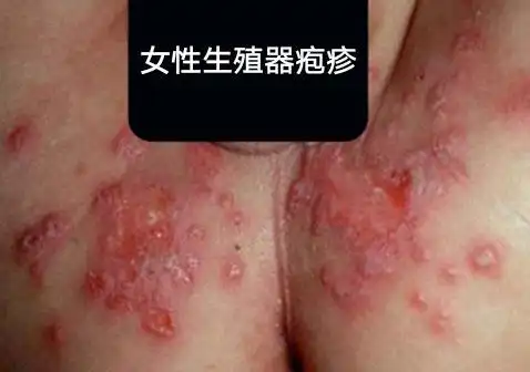 生殖器疱疹图片早期症状表现治疗男女图片