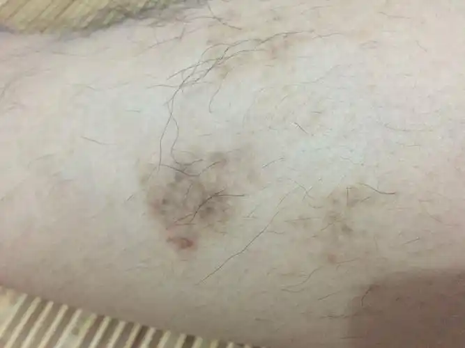 大腿上长了这么一块黑的