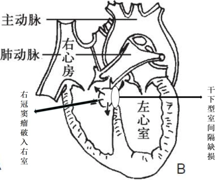 胸心外科成功为"先天性心脏病"患者保留主动脉瓣膜