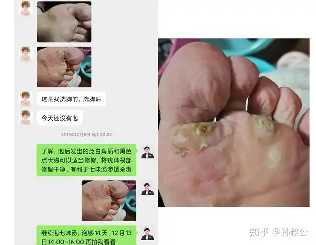 清疣1个半月反馈:好很多了,只剩下一颗了清疣3个月反馈:皮肤基本恢复