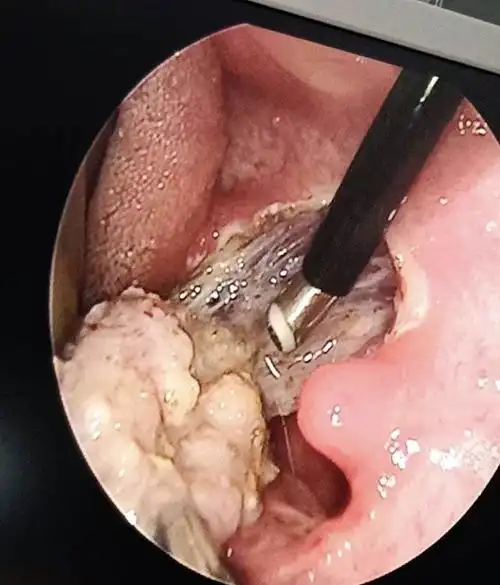 等离子腺样体消融术