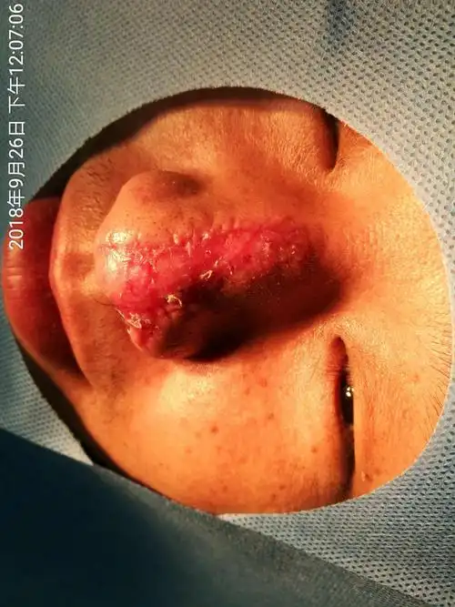 鼻外伤手术一例