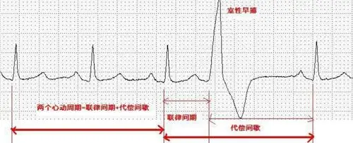 周医生陪您谈"心"第4期:室性早搏很危险吗? - 美篇