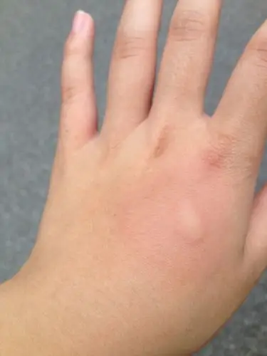 2013-10-17 李翠英 医师 一岁半宝宝左耳淋巴结处被蚊子叮咬后肿大好