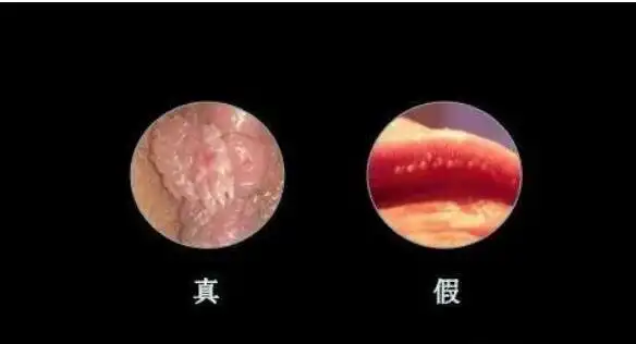 尖锐湿疣和其他的红色丘疹不同,它的刚开始是菜花样小疙瘩或者小颗粒