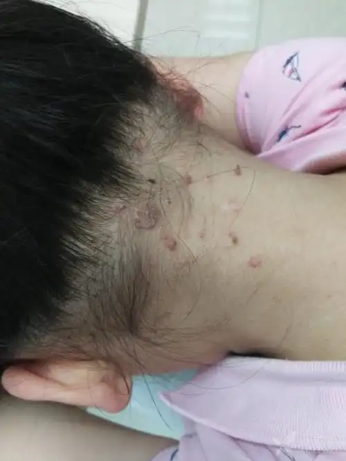 中药内服外敷治疗寻常疣 [病例帖]