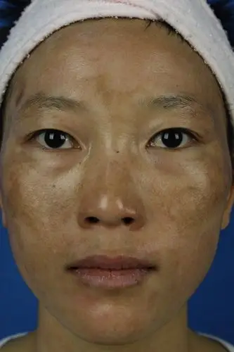 妊娠斑图片 (1)_有来医生