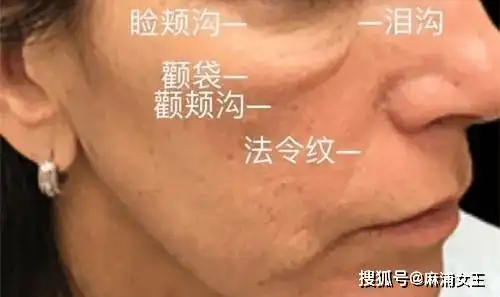 印第安纹老师不会告诉你这些秘密,去除印第安纹需要注意7件事_颧骨