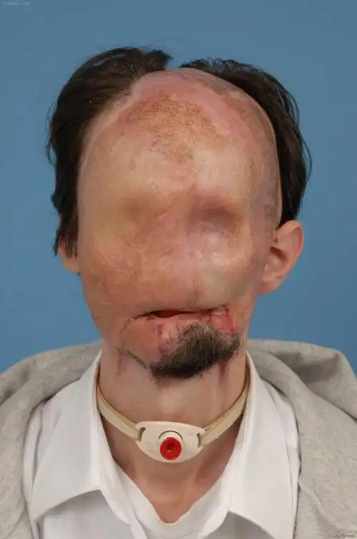 美国人彼得森因为一场车祸从而导致脸部毁容.