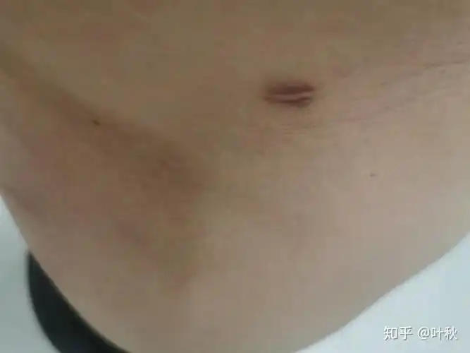 脂肪瘤术后万再一次分享