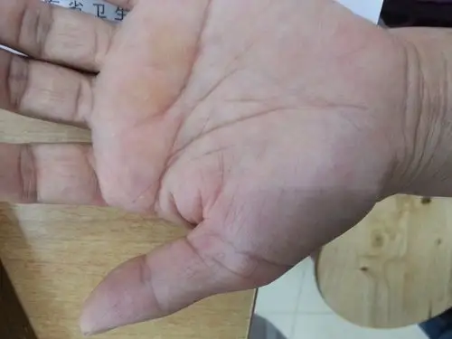 今日门诊见闻双手肌肉萎缩