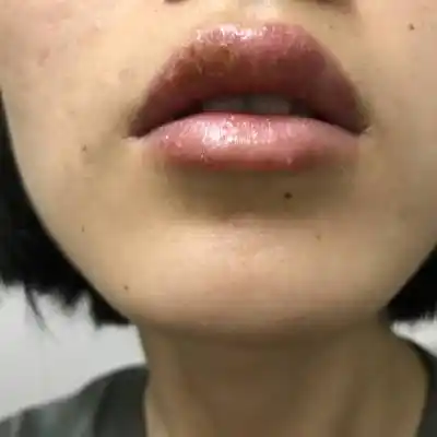 怀孕18周,嘴唇长了疱疹,已经持续2周了,擦了阿昔洛韦,也不见好转,上