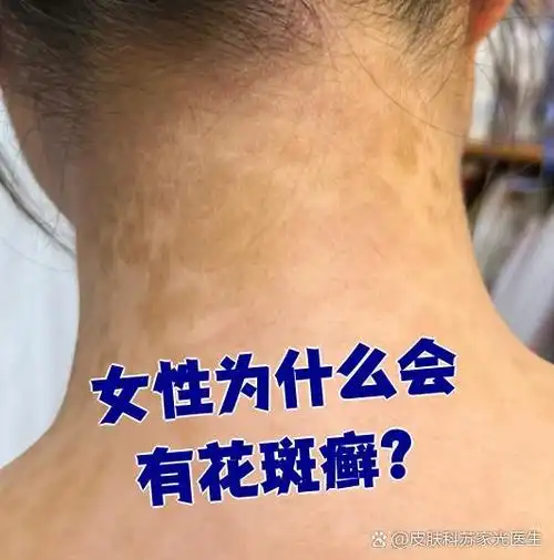 花斑癣是由马拉色菌感染皮肤角质层引起的皮肤病