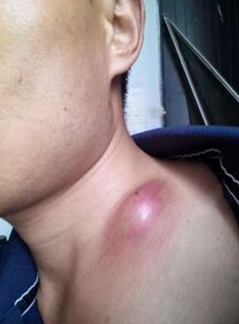 右肘后脂肪瘤图片