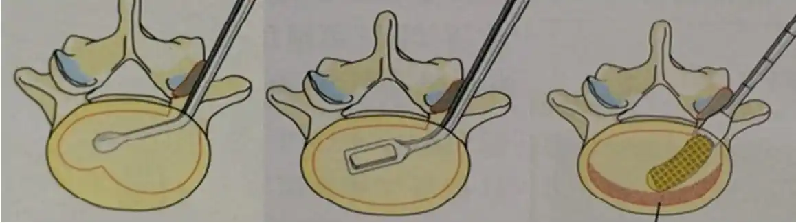 腰椎间盘突出植骨融合术你了解多少