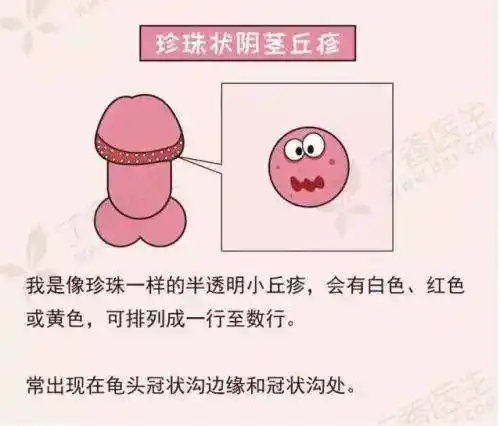 比较容易怀疑的良性病变时阴茎珍珠状丘疹,阴囊湿疹.