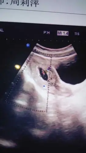 有人说,看孕囊,长条形的话宝宝就是男孩,椭圆形或者圆形为女孩统计