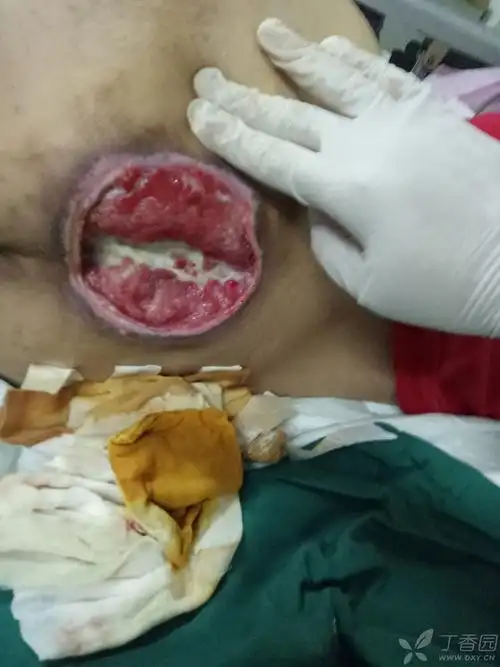 一例褥疮的处理,请大家批评指正 [病例帖]