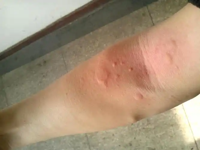 身上起那个红疙瘩,越挠越多,越大片.