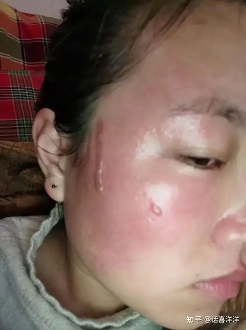 热油烫伤面部记录 - 知乎