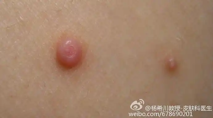 身上长了水猴子怎么破