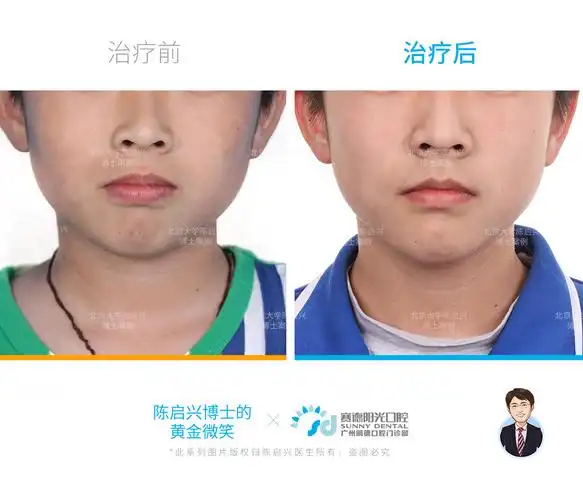 腺样体面容 嘴突 深覆盖 门牙缝过大矫正案例