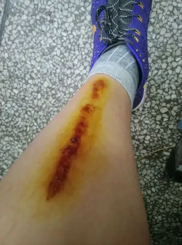 腿上不小心刮开了,现在过了一个星期了还没好,之前只是涂点碘酊,还