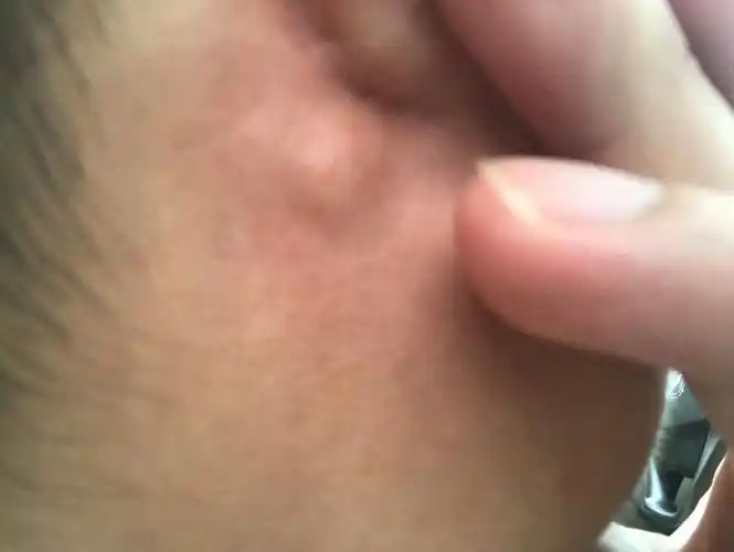 耳朵后面长了一个这个包,是什么情况?