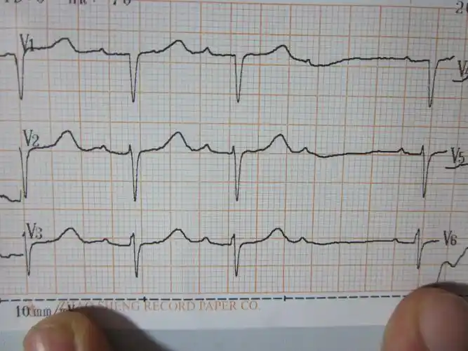二度一型房室传导阻滞