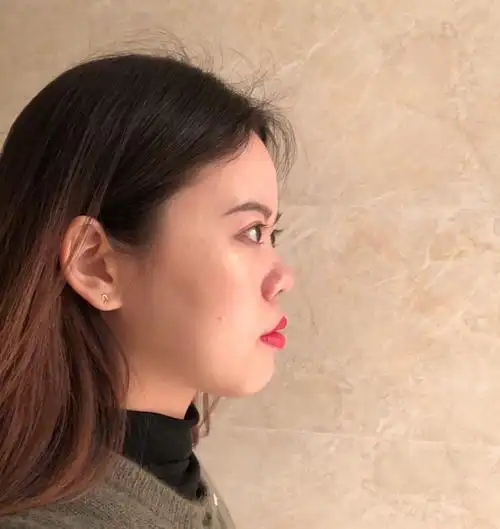 凸嘴星人整牙十个月的侧脸变化