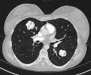 ct显示双肺有多发性钙化病变.