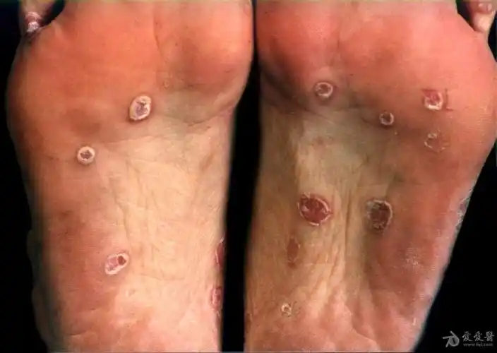 皮肤性病图谱☆有☆奖☆点☆评☆52:二期梅毒疹.