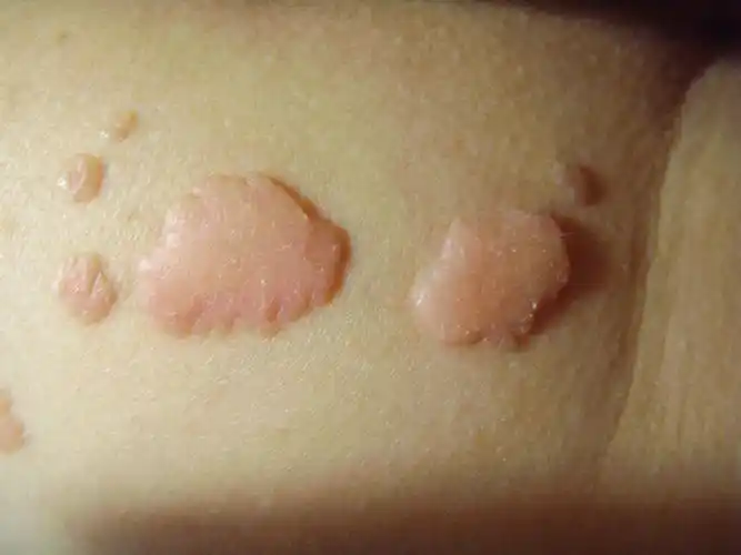 现在仅从图片上来看,是不能明确疣体的性质,建议您到医院的皮肤科