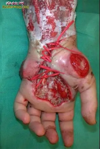 自己处理不当导致腐烂我公司医治的毒蛇咬伤患者,眼镜蛇咬伤导致深度