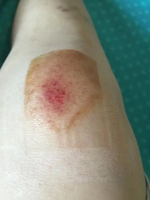 请问腿磕伤怎么处理,今天早上台阶踩空了,双腿膝盖着地,磕伤,用了点