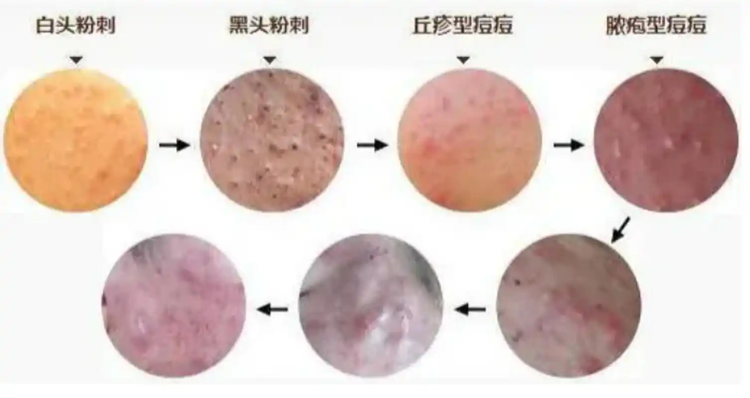 很多人以为脸上长了红点就是痘痘,其实不是,皮肤科苏医生教大家分辨