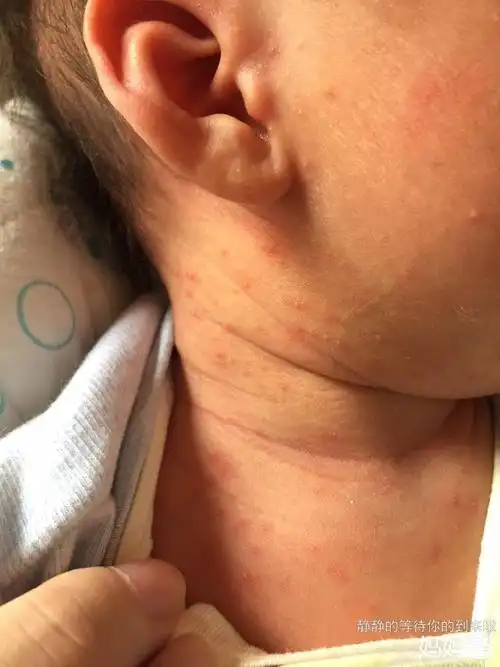 模范!宝宝起湿疹怎么办"生男孩子"-第2张图片-太白博客