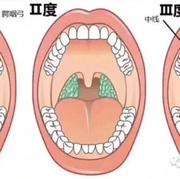 扁桃体肿大的孩子一定要配合我说的