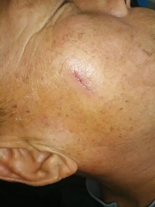 什么是皮肤微创美容手术 - 好大夫在线