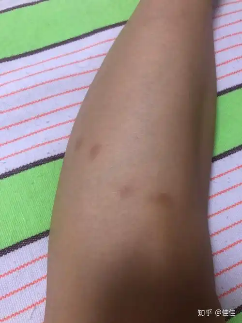 被跳蚤咬的全身都是包是什么样的感受! - 知乎